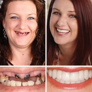 Clinclii™ --Advanced Customized Full Denture Set🦷