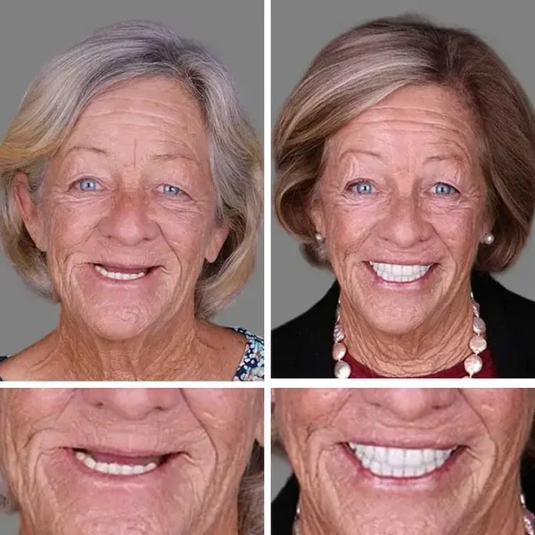 Clinclii™ --Advanced Customized Full Denture Set🦷