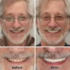 SmileFitPro™–Advanced Custom-Fit Functional Dentures